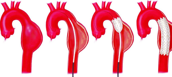 Tăng huyết áp gây biến chứng phình động mạch và cần điều trị bằng cách đặt stent